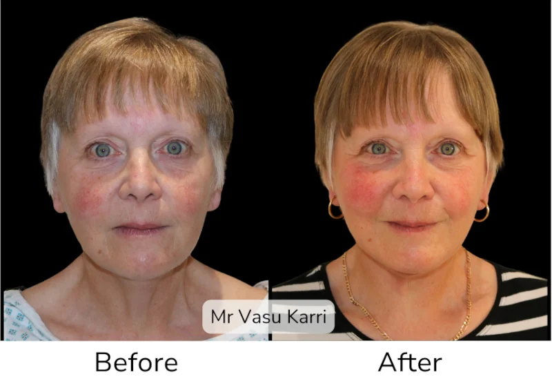 Facelift Patient 12 View 1